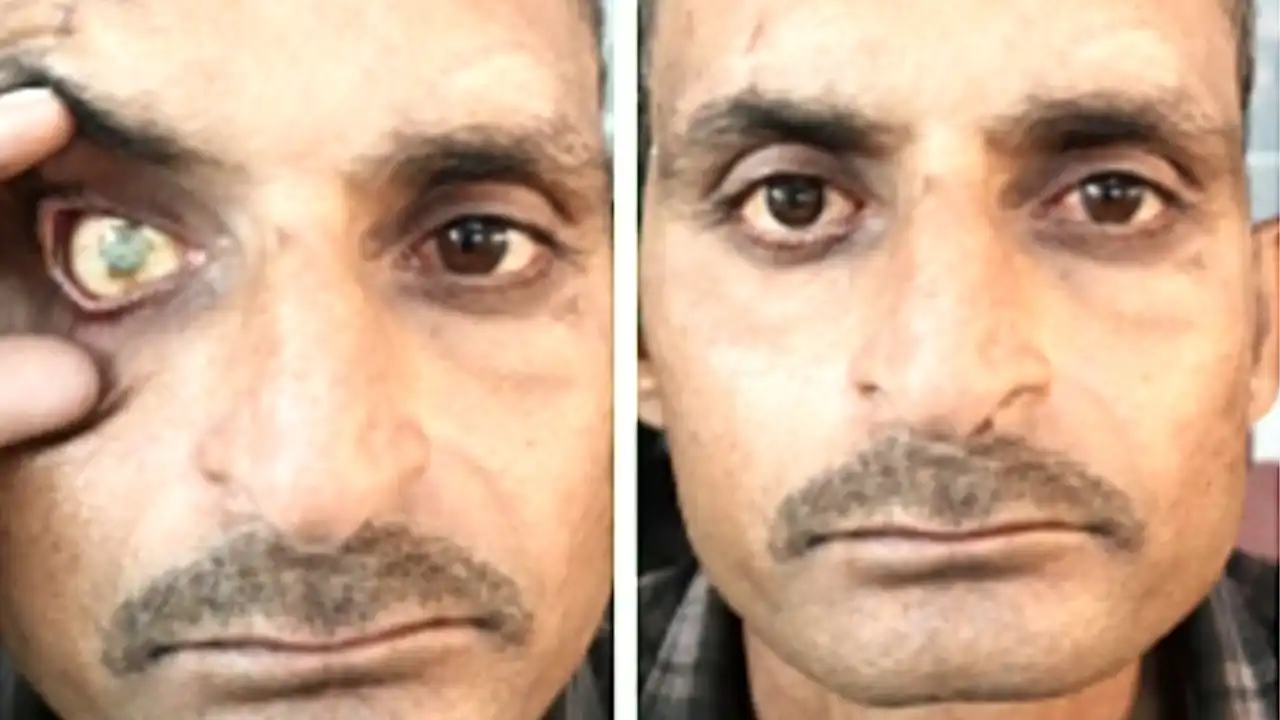 कस्टमाइज़्ड आर्टिफिशियल आई से लौटी मुस्कान और आत्मविश्वास